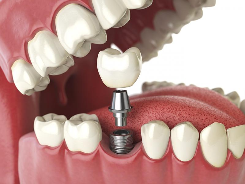 Trồng răng Implant như thế nào, một vài ưu và nhược điểm 1 trong rang implant nhu the nao