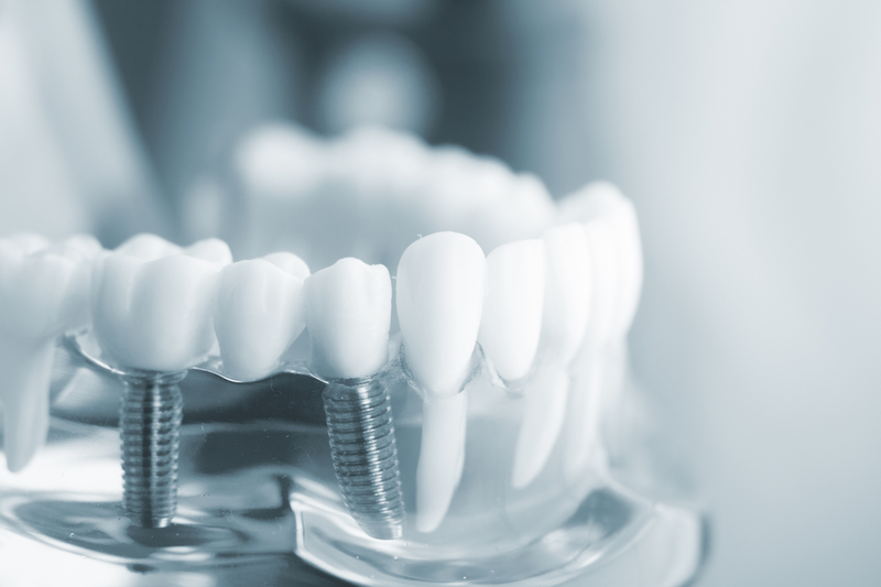 Trồng răng implant review mới nhất 2 Phục hồi răng bằng trồng răng mới