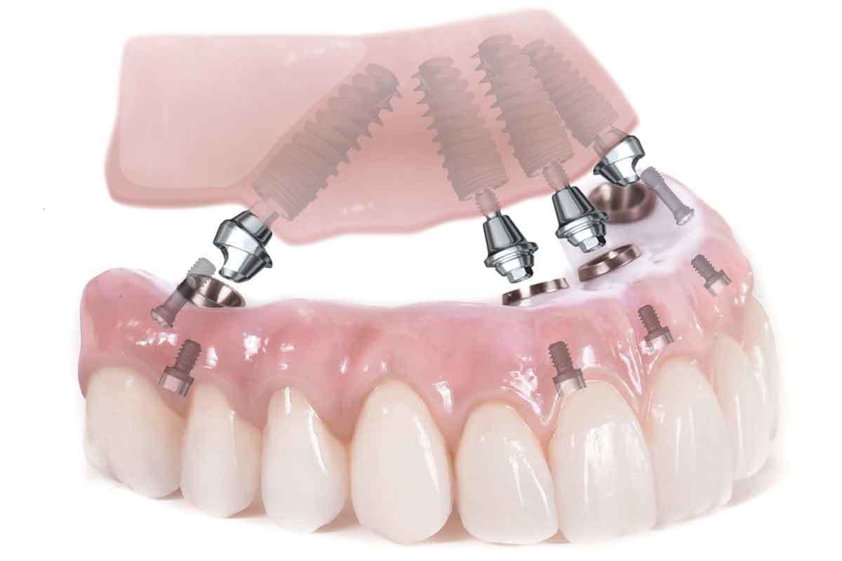Trồng răng implant review mới nhất 1 Trồng răng Atlanta review uy tín nhất