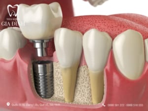 Trồng răng Implant số 6 là giải pháp tuyệt vời để cải thiện sức nhai