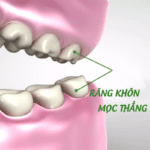 a gia nho rang khon tai bac ninh