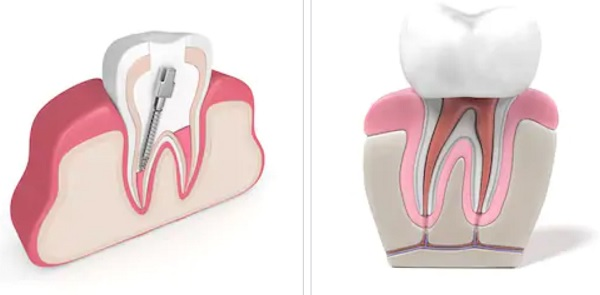 Giá điều trị tuỷ răng tại Bắc Ninh hợp lý, vừa túi tiền 4 Chi phí chữa trị tủy răng tại Nha Khoa Gia Đình BN có nhiều ưu đãi hấp dẫn