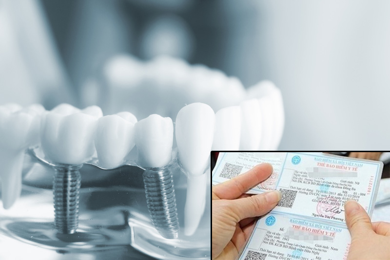 Đi nhổ răng khôn ở đâu? Bệnh viện hay phòng khám tư? 3 Nhổ răng khôn tại bệnh viện sẽ không được hưởng chế độ bảo hiểm y tế.