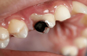 Dấu hiệu để nhận biết chiếc răng bị sâu nặng