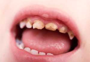 Nên hàn răng sâu kịp thời cho trẻ để tránh hệ lụy sau này