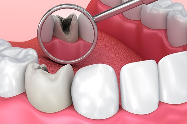 Hàn răng sâu cho trẻ em tại Quế Võ và những thông tin cha mẹ nên nắm rõ 1 Khám hàn răng sâu cho trẻ em tại Quế Võ