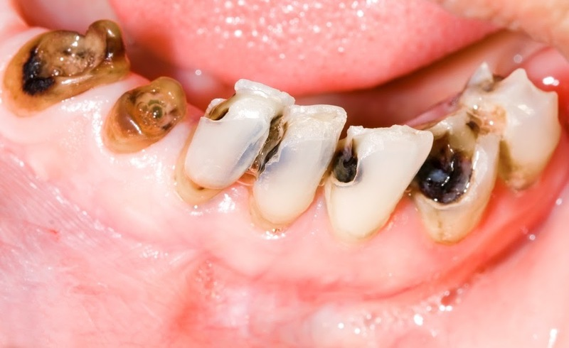 Có nên hàn răng sâu giá rẻ ở Bắc Ninh? Hậu quả khó lường bạn có thể chịu 3 Hàn răng giá rẻ ở Bắc Ninh kém chất lượng gây ra nhiều tác hại nguy hiểm