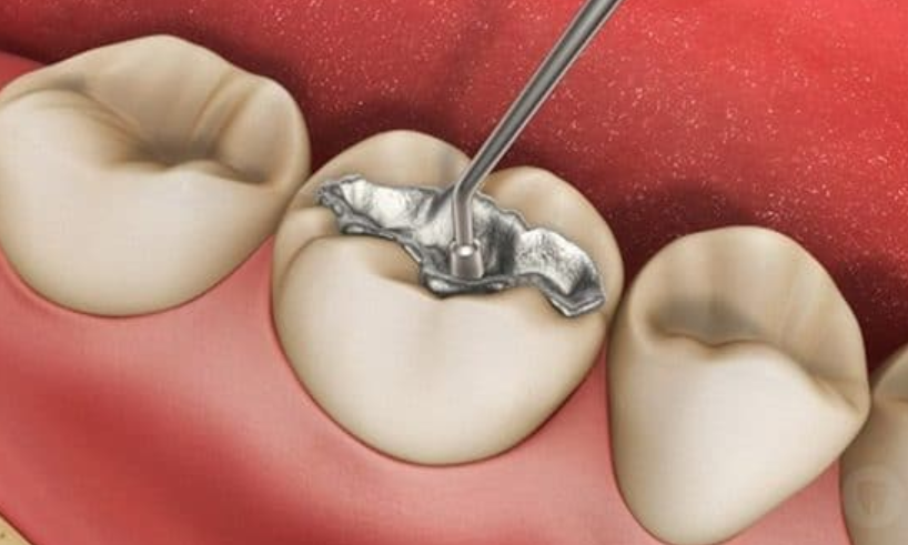 Hàn răng sâu là gì? giải đáp chi tiết về việc hàn răng sâu 3 Quy trình hàn răng sâu có rất nhiều bước