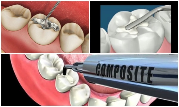 Hàn răng sâu là gì? giải đáp chi tiết về việc hàn răng sâu 1 Hàn răng sâu là gì?