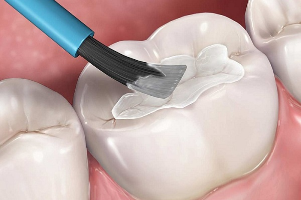 Hàn răng sâu mất bao lâu? Những yếu tố ảnh hưởng đến thời gian hàn răng 2 Có rất nhiều yếu tố ảnh hưởng đến việc trám răng