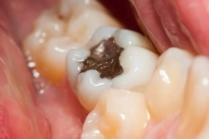 Hàn răng sâu mất bao lâu? Những yếu tố ảnh hưởng đến thời gian hàn răng 3 Vật liệu trám răng bạn lựa chọn ảnh hưởng đến thời gian trám