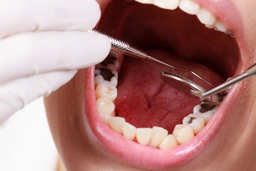 Hàn răng sâu mất bao lâu? Những yếu tố ảnh hưởng đến thời gian hàn răng 4 Kỹ thuật trám của nha sĩ cũng quyết định thời gian bao lâu