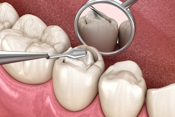 Hàn răng sâu mất bao lâu? Những yếu tố ảnh hưởng đến thời gian hàn răng 1 Hàn răng sâu mất bao lâu?