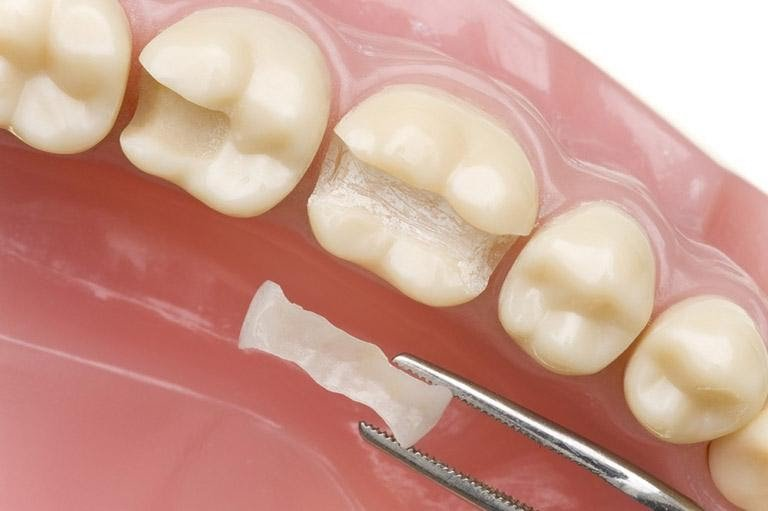 Hàn răng sâu uy tín ở Từ Sơn - Điều bạn cần phải biết 1 Hàn sâu răng uy tín ở Từ Sơn là phương pháp gì?