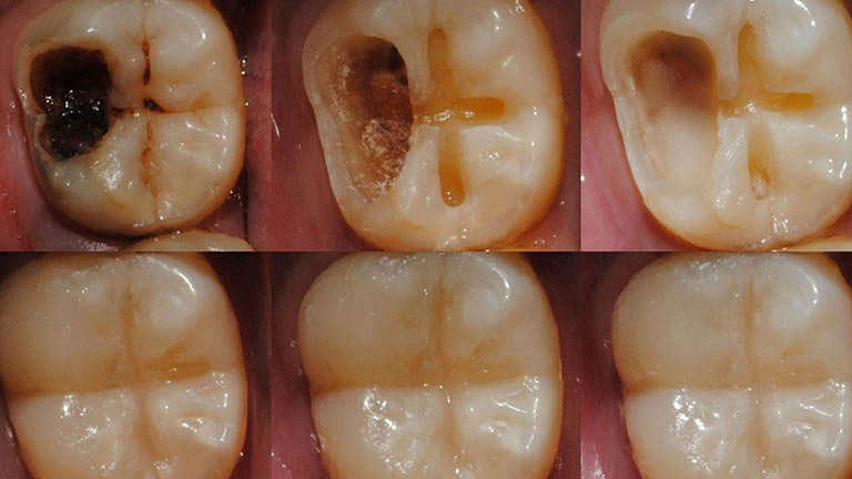 Răng sâu vào tủy có nguy hiểm không? có nên hàn răng sâu vào tuỷ? 3 Nên hàn răng sâu vào tủy nếu phát hiện sớm
