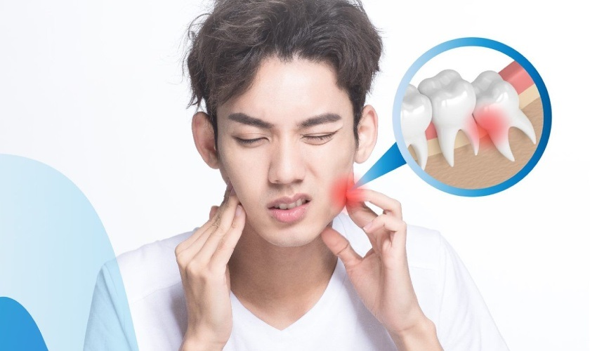 Các trường hợp nhổ răng không được hưởng BHYT là gì?