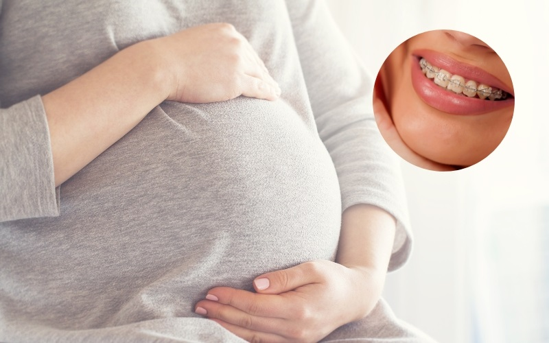 Có bầu niềng răng được không? Những lưu ý bạn nên biết 1 Có bầu niềng răng được không? Những lưu ý bạn nên biết