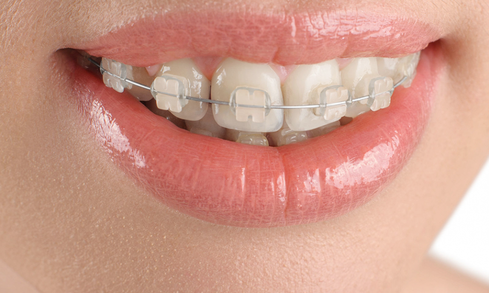 Top 4 lợi ích của niềng răng? Các phương pháp niềng răng phổ biến 4 Phương pháp niềng răng mắc cài sứ được nhiều người lựa chọn