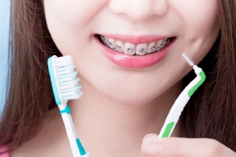 Bỏ túi 6 lưu ý khi niềng răng để đạt hiệu quả tốt nhất 2 Vệ sinh răng miệng khi đang niềng răng