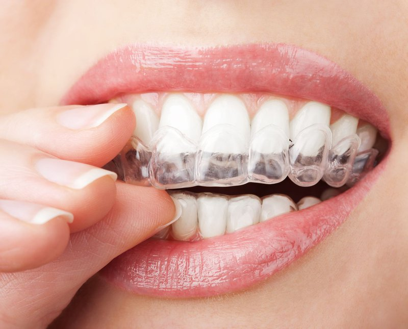 Máng niềng răng là gì? 4 lợi ích mang niềng răng có thể mang lại 2 Rất nhiều trường hợp khiến răng trở nên lệch lạc so với vị trí ban đầu