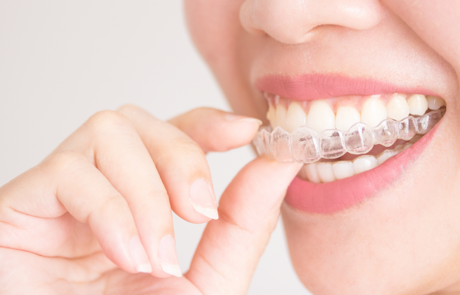 Máng niềng răng là gì? 4 lợi ích mang niềng răng có thể mang lại 3 Thiết kế đẹp là một trong các ưu thế mà máng niềng răng mang lại