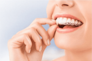 Máng niềng răng - Lựa chọn hàng đầu mang đến hàm răng đẹp