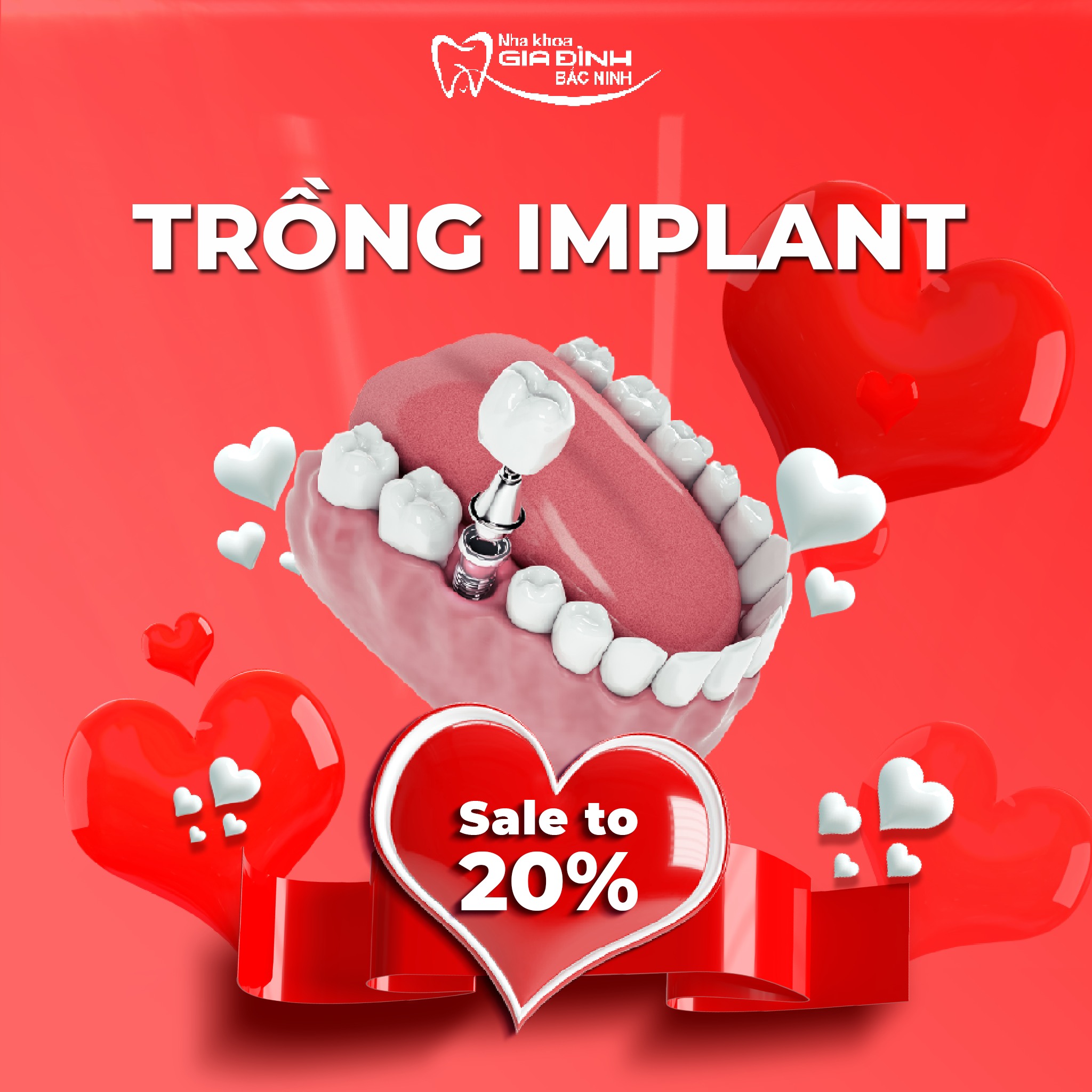 nha khoa gia đình Bắc ninh giảm giá đến 20% trồng răng implant ngày Valentine 2023