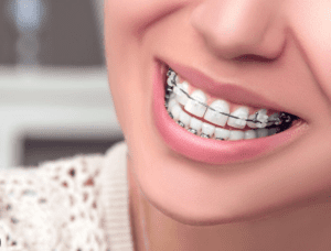 Làm sao để giảm được cơn đau khi tham gia niềng răng?