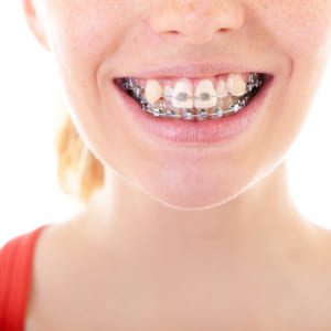 Niềng răng khểnh là kéo răng về vị trí khớp cắn