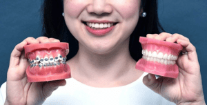 Niềng răng lệch khớp cắn giúp răng đều đẹp hơn