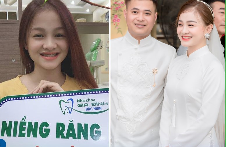Niềng răng mắc cài & dịch vụ chỉnh nha uy tín giá tốt tại Bắc Ninh 2 Niềng răng mắc cài pha lê khó bị phát hiện