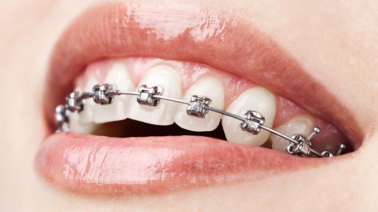 Niềng răng mắc cài & dịch vụ chỉnh nha uy tín giá tốt tại Bắc Ninh 1 Niềng răng mắc cài kim loại có độ chắc chắn cao