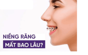 Niềng răng mất bao lâu thì đều và đẹp?