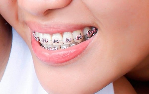 Niềng răng quặp có được không? Niềng răng có phức tạp không? 2 Niềng răng có thể cải thiện tình trạng răng quặp