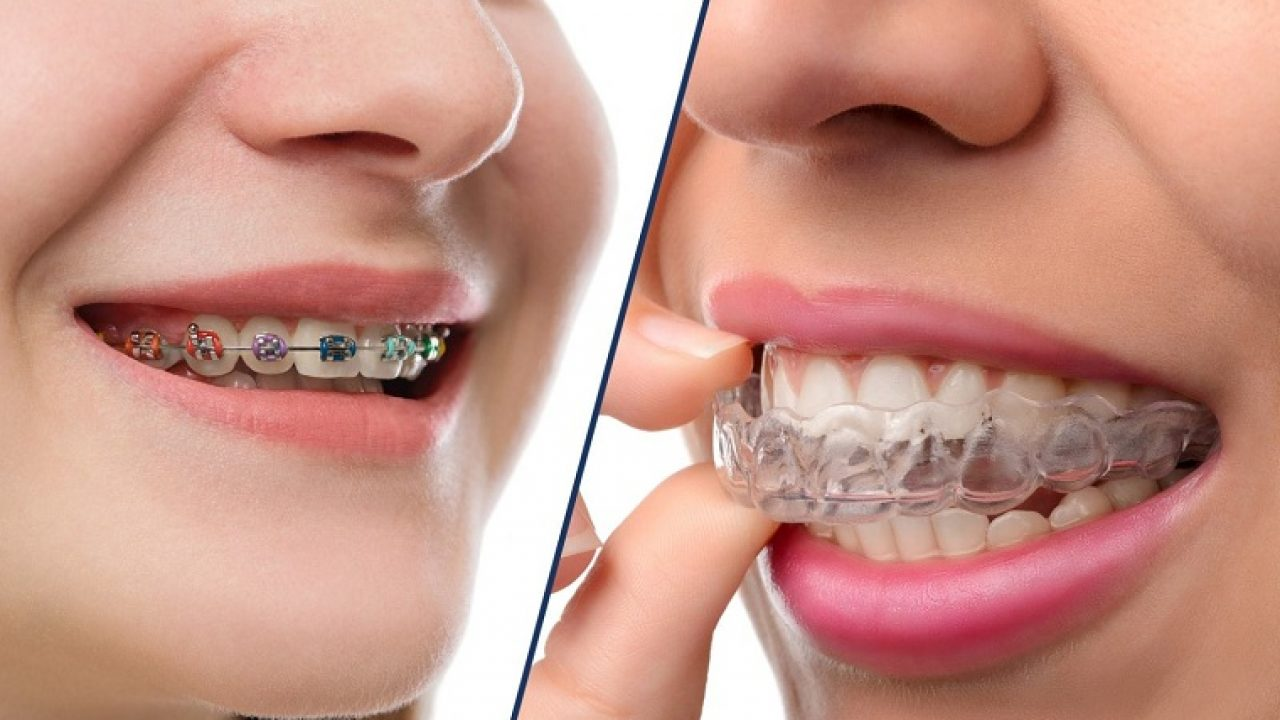 Niềng răng quặp có được không? Niềng răng có phức tạp không? 3 Có nhiều phương pháp niềng răng để bạn lựa chọn