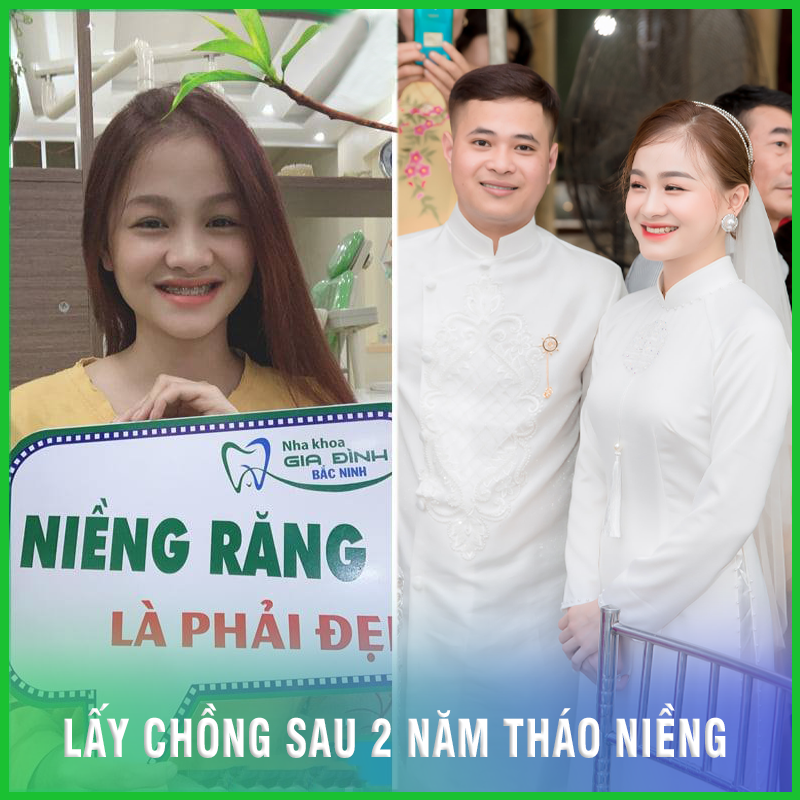 Dịch vụ niềng răng trả góp chất lượng tại Bắc Ninh 4 Thay đổi cuộc sống nhờ niềng răng trả góp