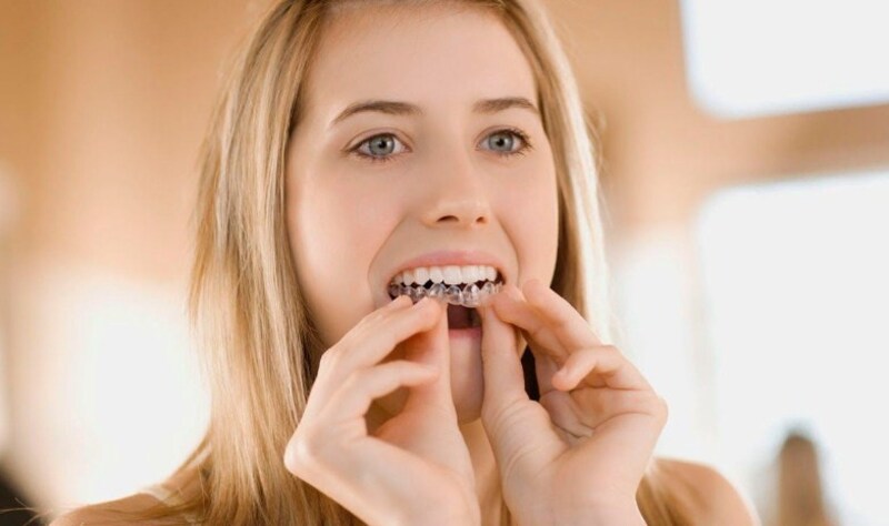 Niềng răng trong suốt - Chi phí và dịch vụ uy tín tại Bắc Ninh 2 Niềng răng trong suốt Invisalign được lựa chọn nhiều nhất
