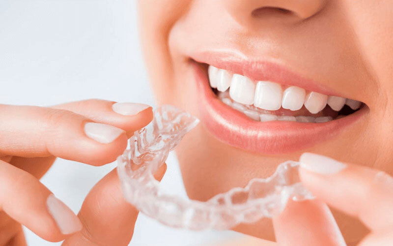 Niềng răng trong suốt - Chi phí và dịch vụ uy tín tại Bắc Ninh 1 Chỉnh nha hiện đại bằng niềng răng trong suốt