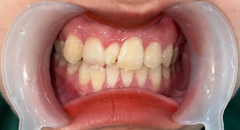 Bắt đầu niềng răng chỉnh nha cho khách nữ bị khấp khểnh và có răng kẹ tại Bắc Ninh 1 Hàm răng khách nữ Bắc Ninh khi chưa niềng
