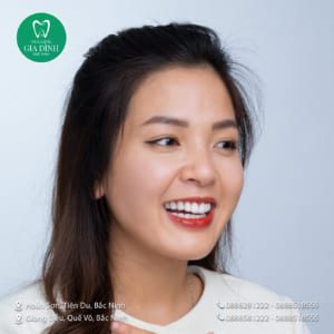 Khách hàng nha khoa gia đình bắc ninh - khắc phục triệt để tình trạng răng ố vàng và khấp khểnh khách nữ