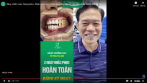Răng nhiễm màu Tetracycline ố vàng - Khắc phục sau 2 ngày tẩy trắng răng và bọc răng sứ tại NKGĐ Bắc Ninh