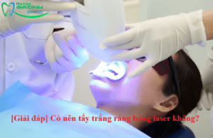 [Giải đáp] Có nên tẩy trắng răng bằng laser không?