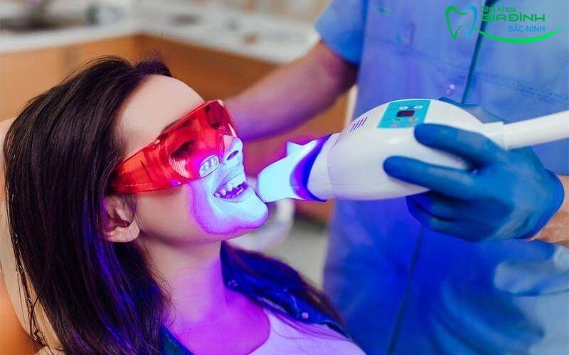 Các công nghệ tẩy răng nha khoa phổ biến hiện nay 2 Công nghệ tẩy trắng răng Laser Whitening của Hoa Kỳ
