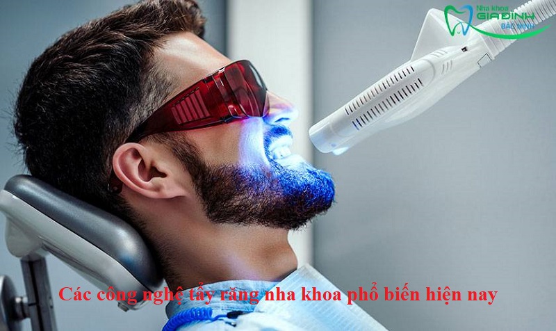 Các công nghệ tẩy răng nha khoa phổ biến hiện nay 1 Các công nghệ tẩy răng nha khoa phổ biến hiện nay