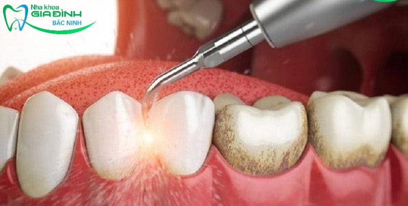 Hỏi đáp nhanh: Lấy cao răng bằng máy siêu âm hiệu quả không? 2 Bác sĩ nha khoa khuyến cáo mỗi người cần thực hiện lấy cao răng theo định kỳ 1 năm 2 lần