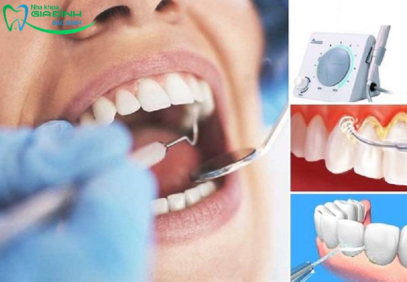 Hỏi đáp nhanh: Lấy cao răng bằng máy siêu âm hiệu quả không? 3 Lấy cao răng bằng kỹ thuật sóng siêu âm còn giúp hạn chế tình trạng xâm lấn