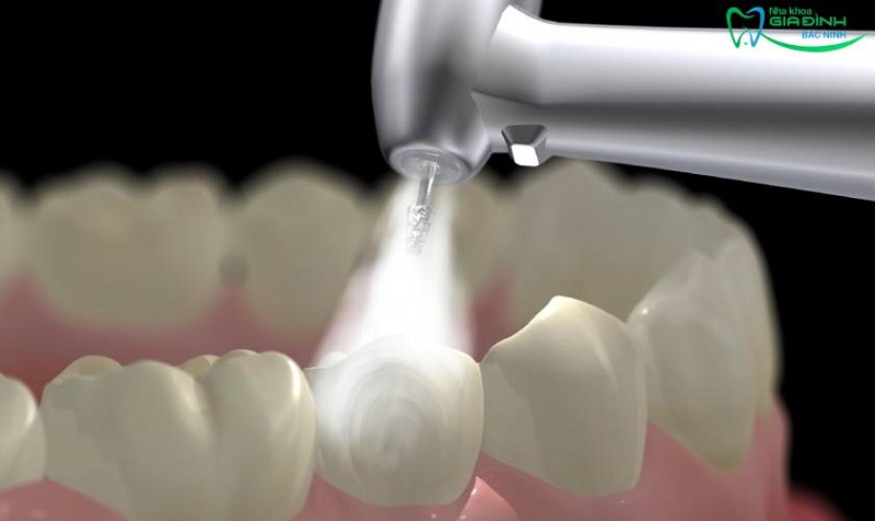 Hỏi đáp nhanh: Lấy cao răng bằng máy siêu âm hiệu quả không? 4 Giá lấy cao răng bằng máy siêu âm khá "hạt dẻ"