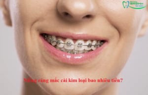 Niềng răng mắc cài kim loại bao nhiêu tiền?