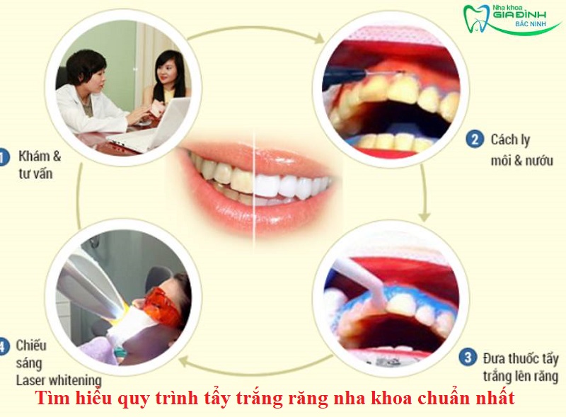 Tìm hiểu quy trình tẩy trắng răng nha khoa chuẩn nhất 15 Tìm hiểu quy trình tẩy trắng răng nha khoa chuẩn nhất