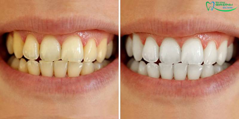 Hỏi đáp nhanh: Khi nào nên tẩy và không nên tẩy răng nha khoa? 2 Khách hàng có hàm răng khỏe mạnh, không bị viêm lợi hay mài mòn nên tẩy răng